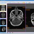 Как да отваряте и четете CT и MRI дискове?